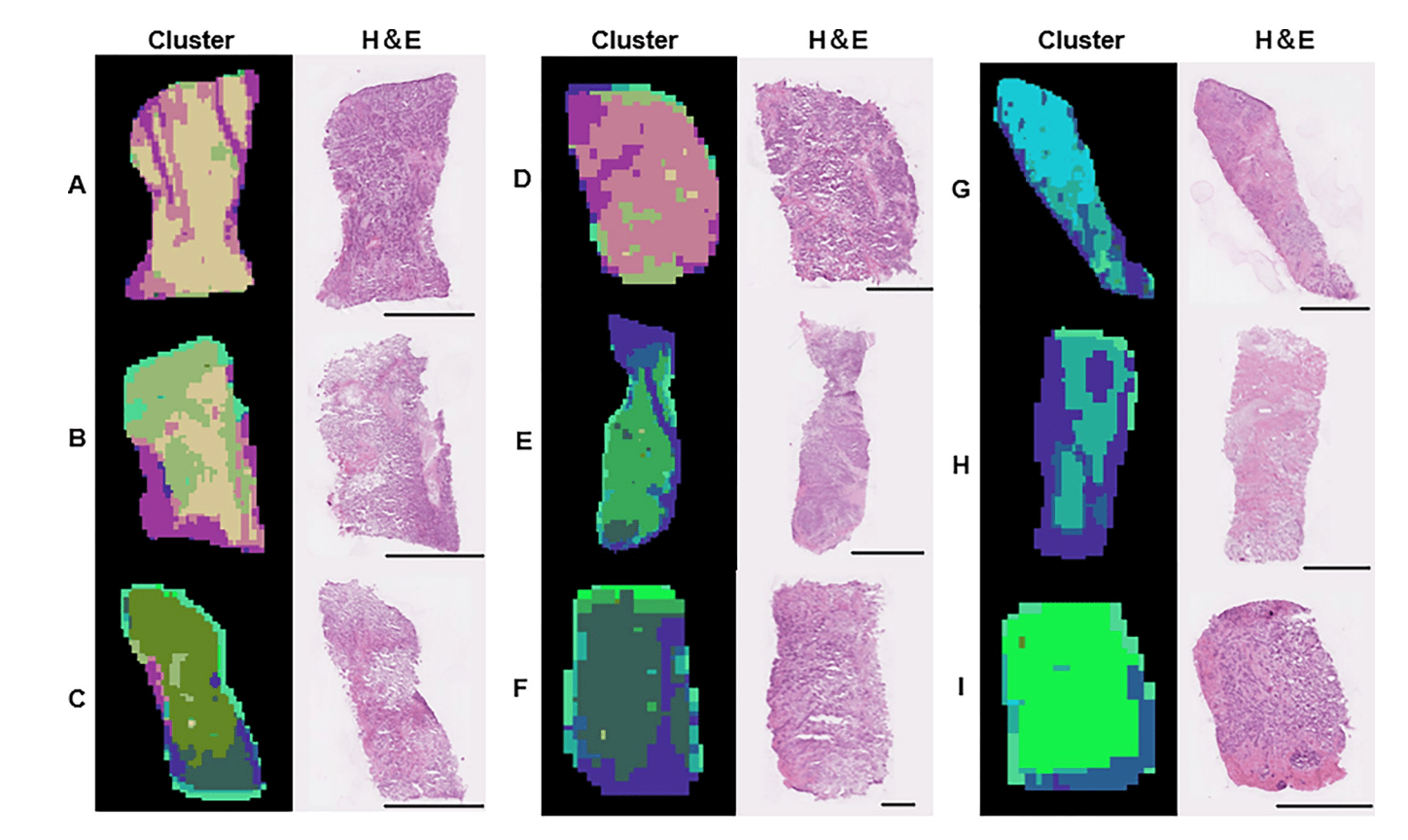Lipidomicsbased tissue heterogeneity in specimens of luminal breast